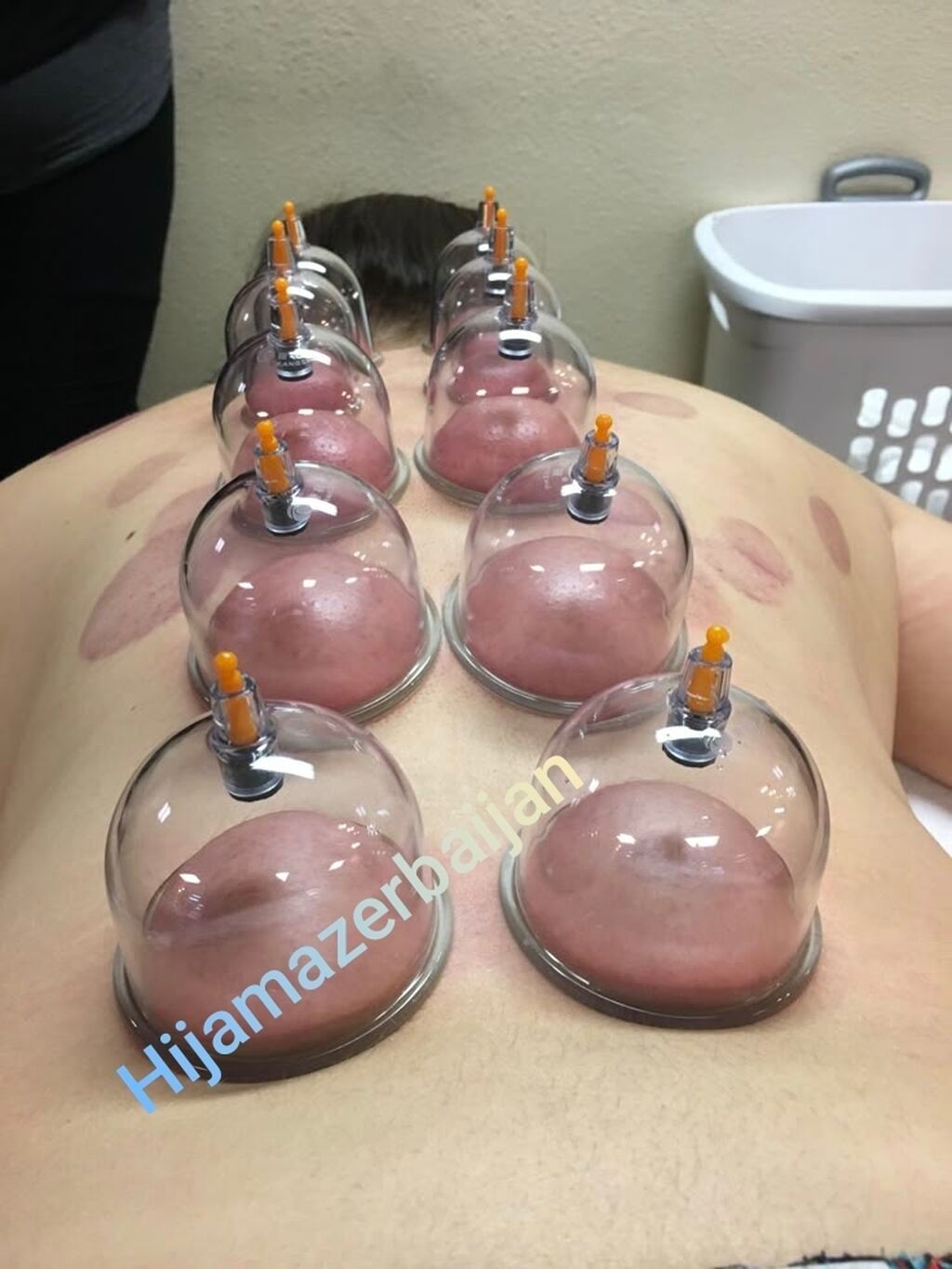 Hijama Həccəm xidməti - 2