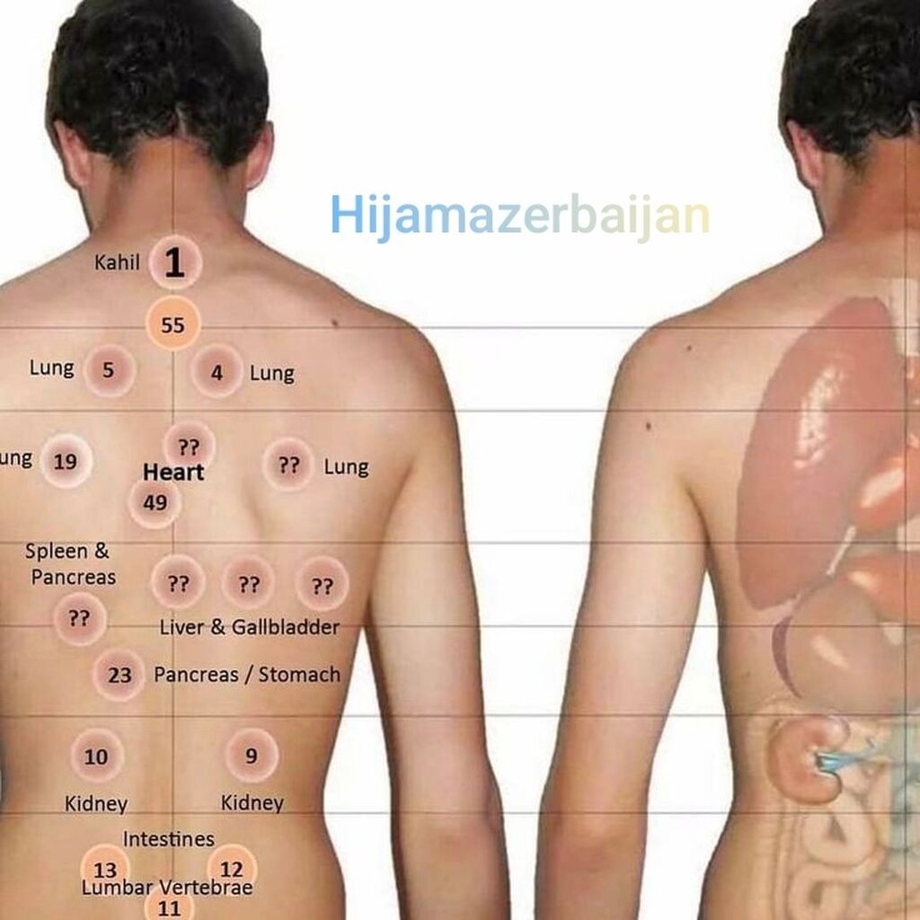 Hijama Həccəm xidməti - 3