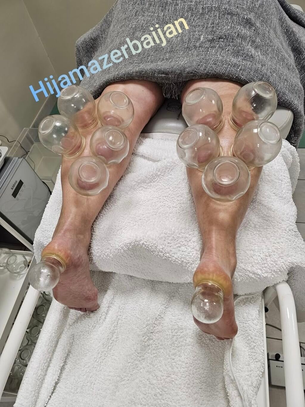 Hijama Həccəm xidməti - 4