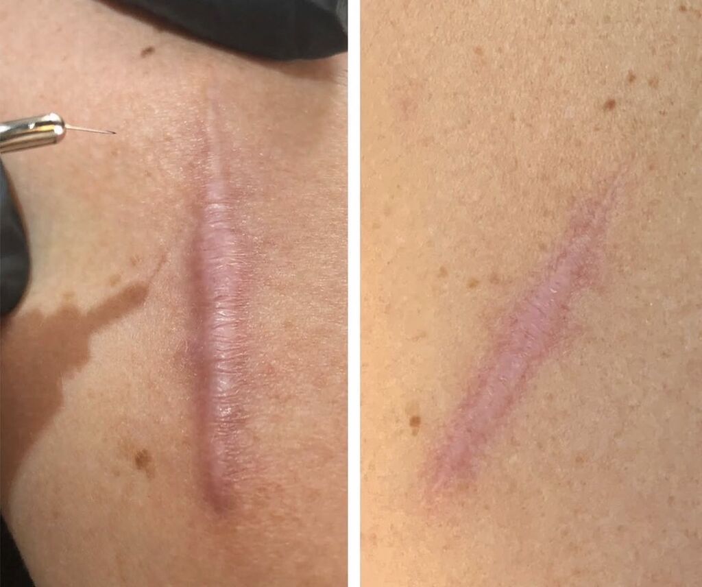Keloid və əməliyyat çapıqlarının müalicəsi - 2