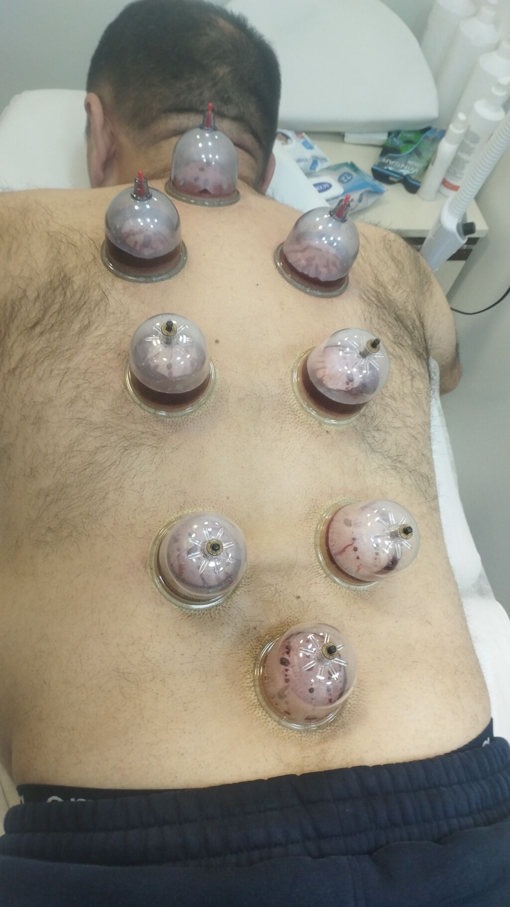 Hicama və banka terapiyası xidməti - 2